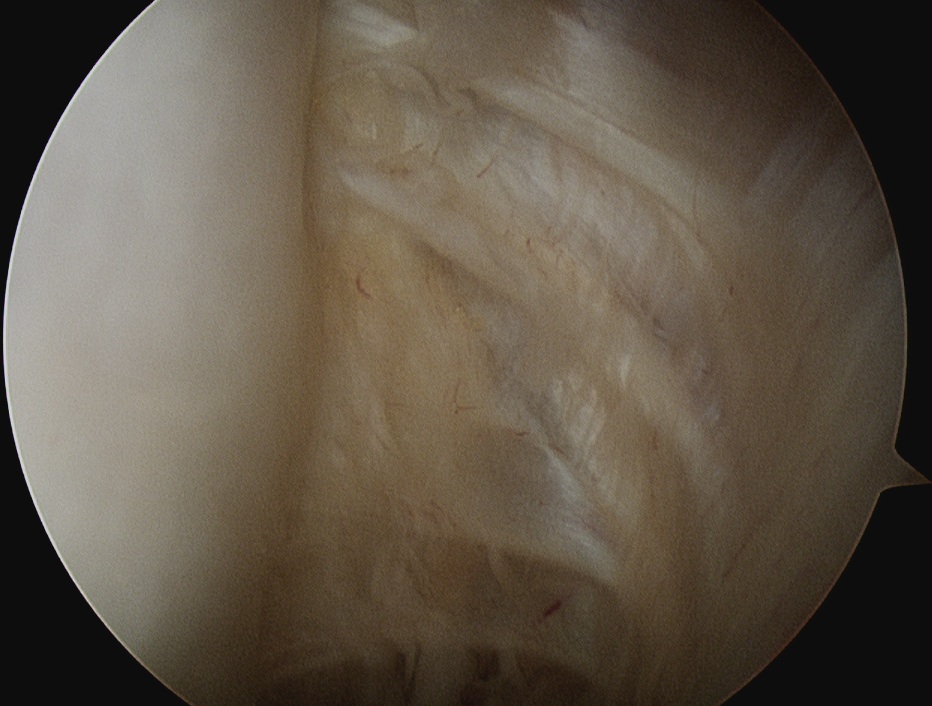 Shoulder Arthroscopy Infraspinatous Insertion